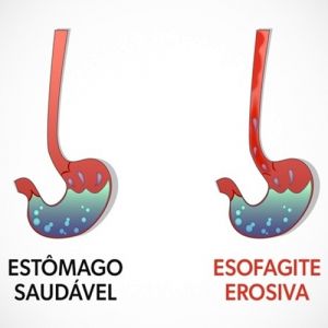 Esofagite Erosiva: O Que é, Tratamento E Classificação De Los Angeles ...